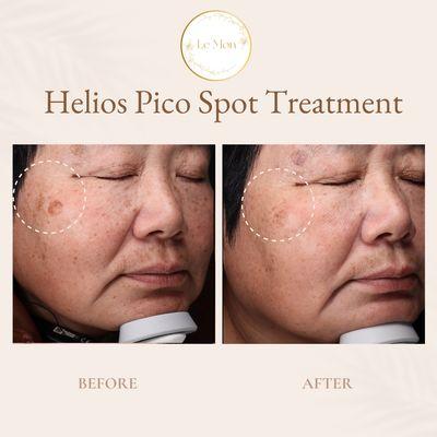 Helios Pico Spot Treatment: Age Spots & Sunburn