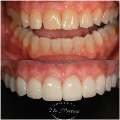 Beautiful and natural looking porcelain veneers.