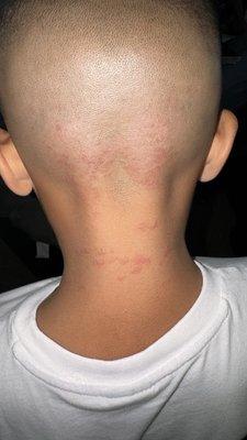 Rash from barber not sanitizing his equipment.