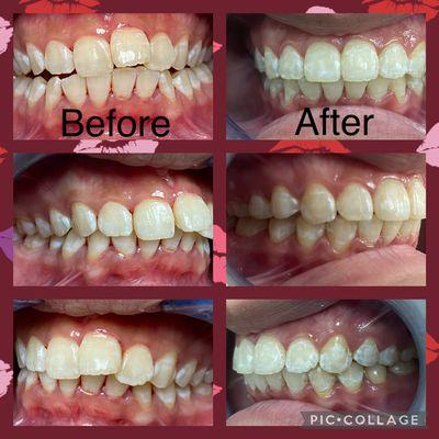 18 months orthodontic treatment