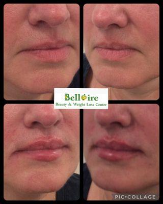 Lip and marionette line filler