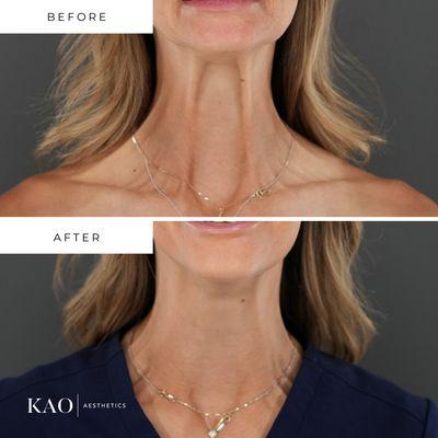 Before and after neck neurotoxins