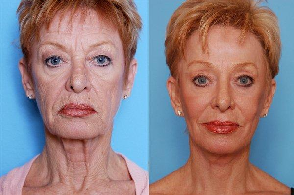 Facelift, neck lift, brow lift, blepharoplasty, CO2 laser