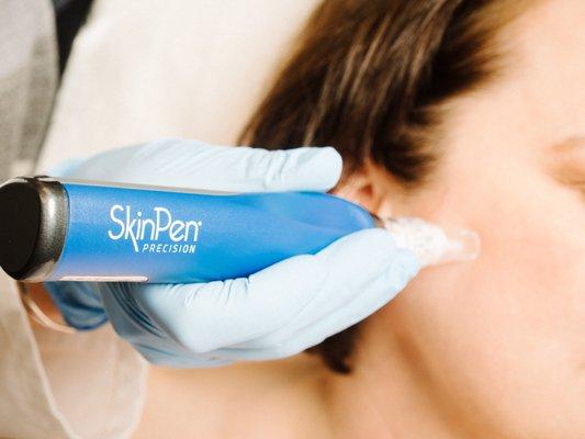 Microneedling with SkinPen