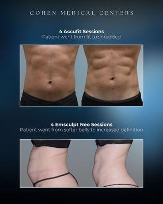 Transform with Accufit & Emsculpt Neo at Cohen Medical Centers! Enhance muscle, reduce fat, and sculpt your body. Discover your best  self!