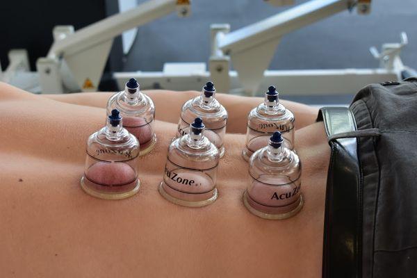 Cupping