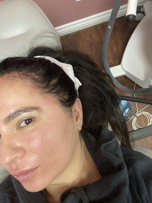 Post microneedling and PRP for hair growth @hairline!