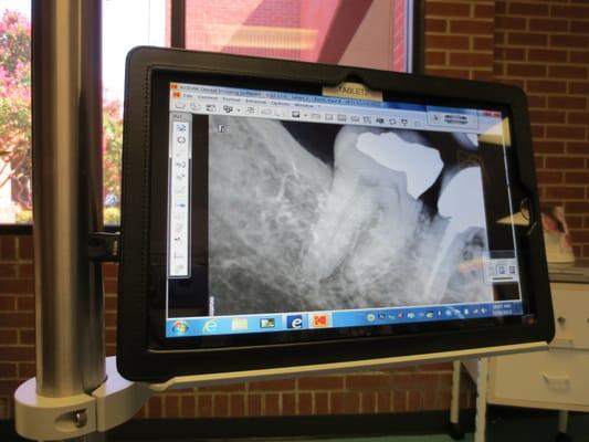 Digital x-rays, wifi enabled with intraoral camera