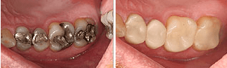 restoring old, failing, silver fillings in a single appointment using CEREC technology