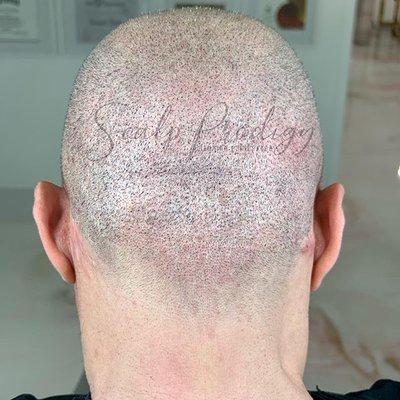 Scalp Micropigmentation for  FUT repair.