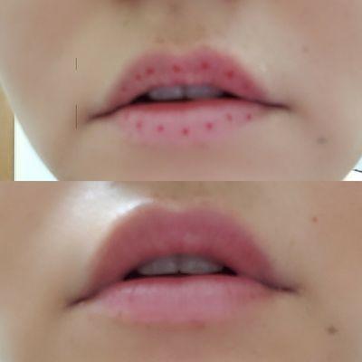 Needle free lip filler