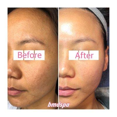 Before & After | Vivace RF Microneedling  | 1 treatment |