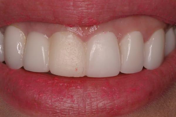 my veneers from BEFORE DR. WONG from previous dentist (the yellow tooth was a temporary)