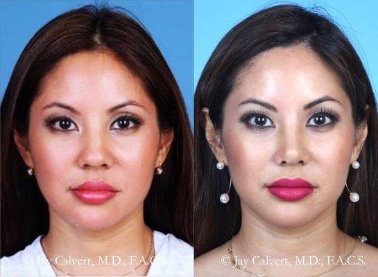 Asian Rhinoplasty by Dr Jay Calvert