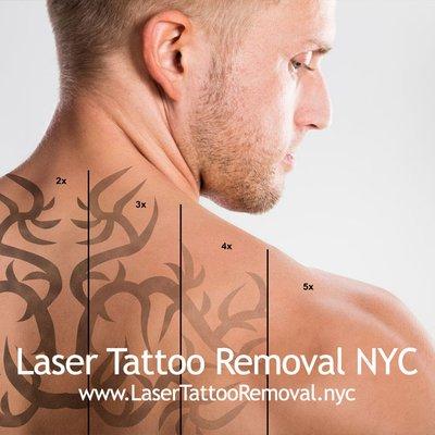 Laser Tattoo Removal NYC