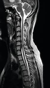 Forward head carriage (postural) & disc bulge