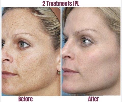 Sun spots, age spots, and pigment; here today and gone tomorrow!! Fantastic results in just 2 treatments!!