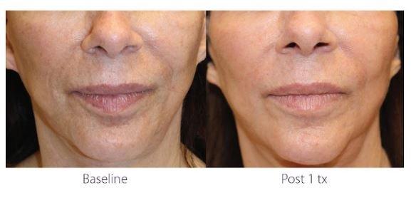 Opus Plasma Before & After