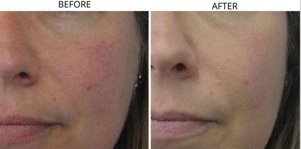 IPL treatment: Before and after