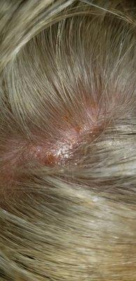 Chemical burns on scalp I had pus coming out