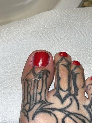 Toe Infection