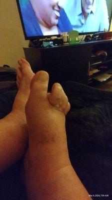 Rheumatoid arthritis toes are starting to bend under and stay like that