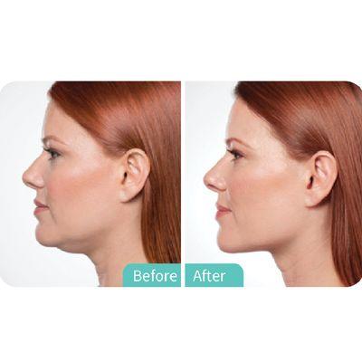 Kybella fat dissolving injection