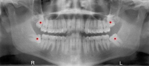 Tooth Extractions and Wisdom Teeth Removal