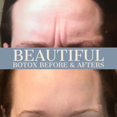 Botox Before and After Pictures