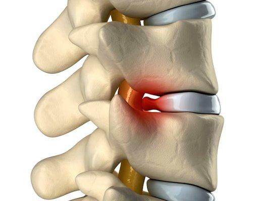 Decompression may be your best treatment choice. https://www.chiromedicalgroup.com/blog/decompression-or-physical-therapy