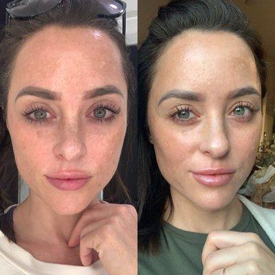 Left is before the peel- right is 9 days after. Our goal was to reduce dark spots and even skim tone.