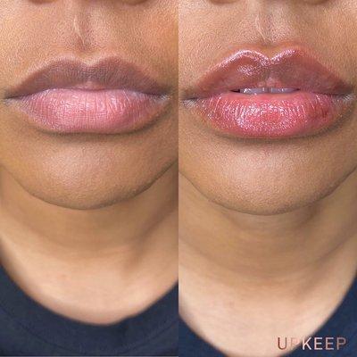 LIP FILLER