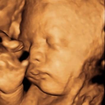 3D / HD Ultrasound - B.B. Precious, Ultrasound Imagery Studio