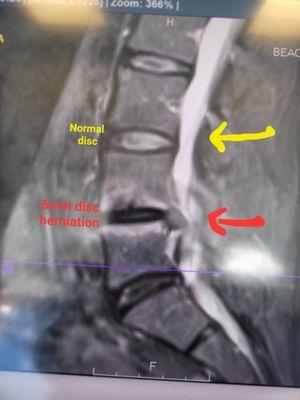 Herniated disc