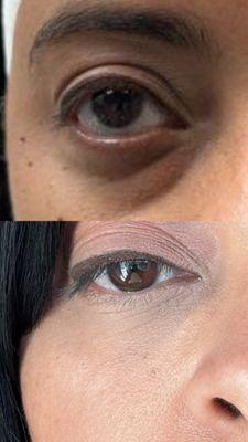 Before and immediately after under eye filler