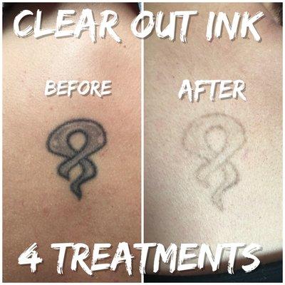 Wow! After 4 treatments. Call us for a FREE consultation.