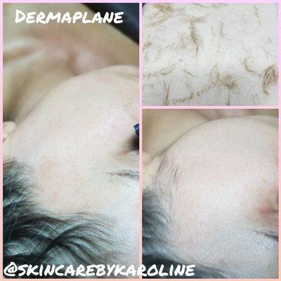 Dermaplane