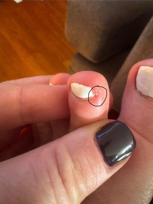 Infected toe