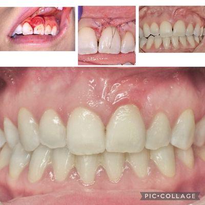 Periodontal Micro-Plastic Surgery Removal of the "pyogenic granuloma" and regeneration of the papilla (gum)