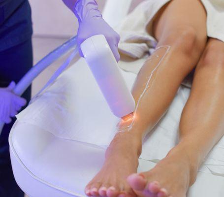 Laser hair removal