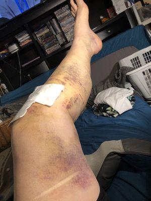 Complete leg reconstruction of ACL, Dr. Kenneth Berliner Katy Freeway Lauren Lone Star Orthopedics