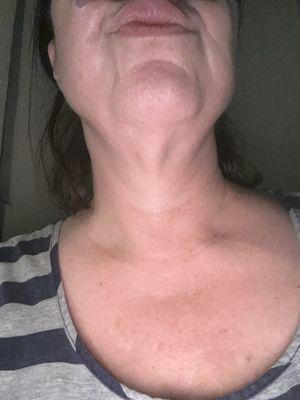 Lower facelift and neck lift, these are the returns....big fat nothing!!!