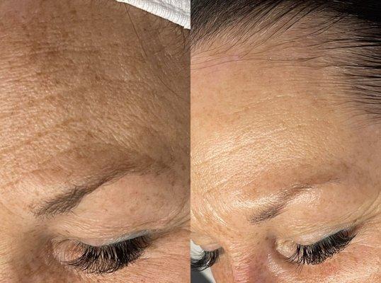 Platinum hydrafacial