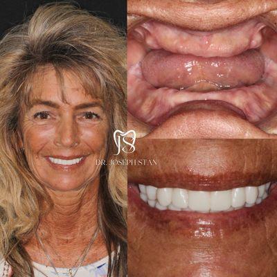 Dental Implants at Smile Boutique