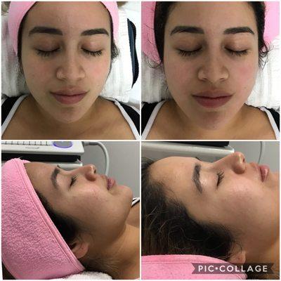 anti aging facial - instantly lifted smile lines