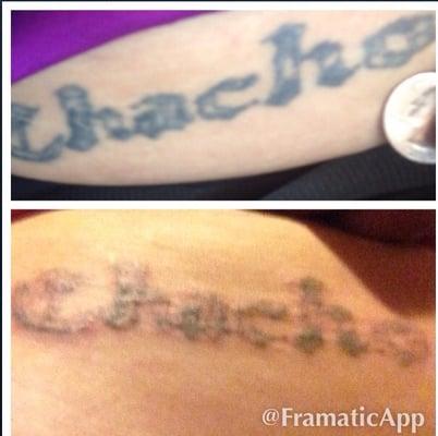 After just one treatment of laser tattoo removal! Very good pricing