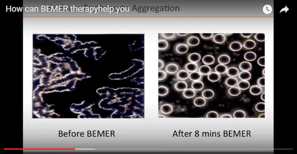 Blood cells before and after a Bemer session.