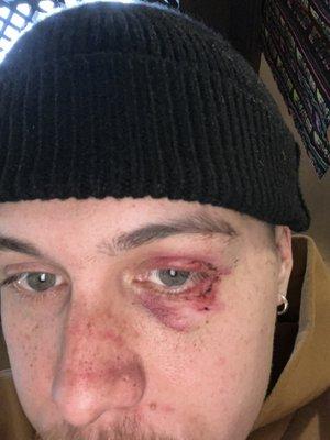 Black eye RECEIVEDfrom ROCKLIN POLICE OFFICER