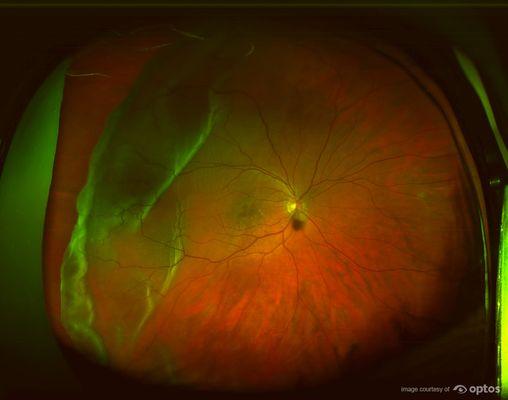 Retinal Detachment