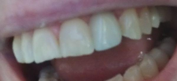 Dr. Dibble installed this permanent, custom colored implant. Very poor outcome!